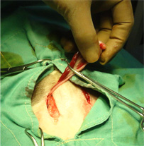 ソ径部停留睾丸の手術2