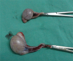 ソ径部停留睾丸の手術3